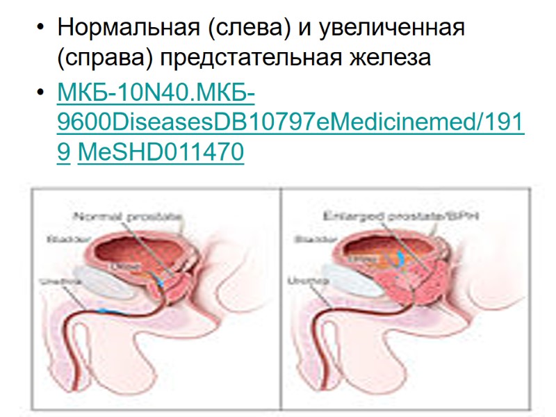 Нормальная (слева) и увеличенная (справа) предстательная железа МКБ-10N40.МКБ-9600DiseasesDB10797eMedicinemed/1919 MeSHD011470
